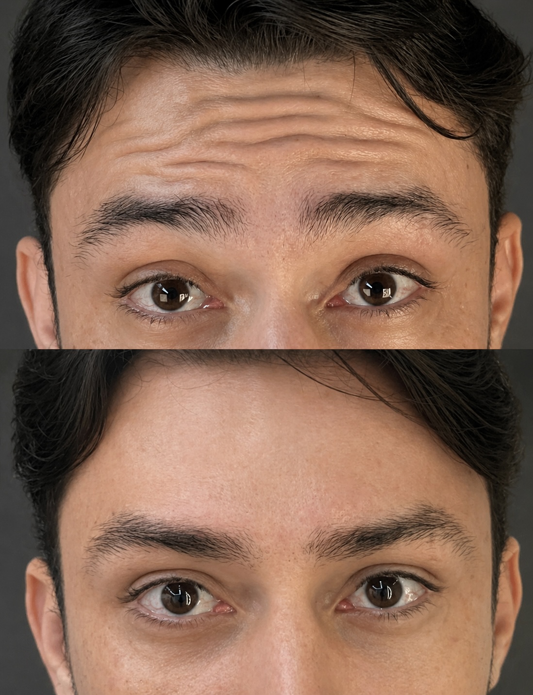 Antes e depois — Botox